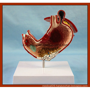 Human Stomach with Ulcers Anatomical Model